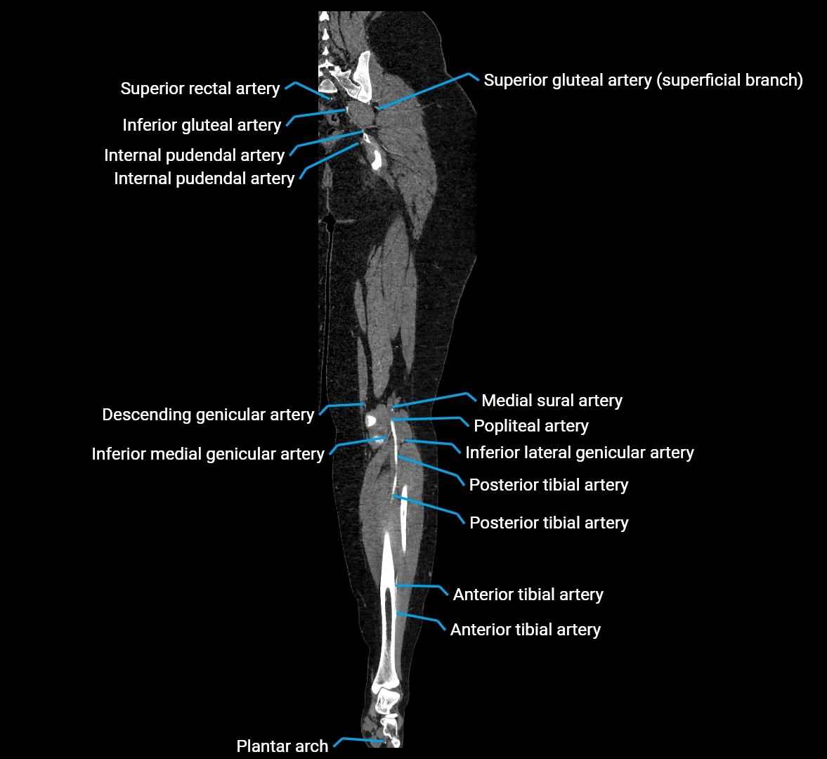 CTA lower limb coronal cross sectional anatomy labelled image _62 (2).webp